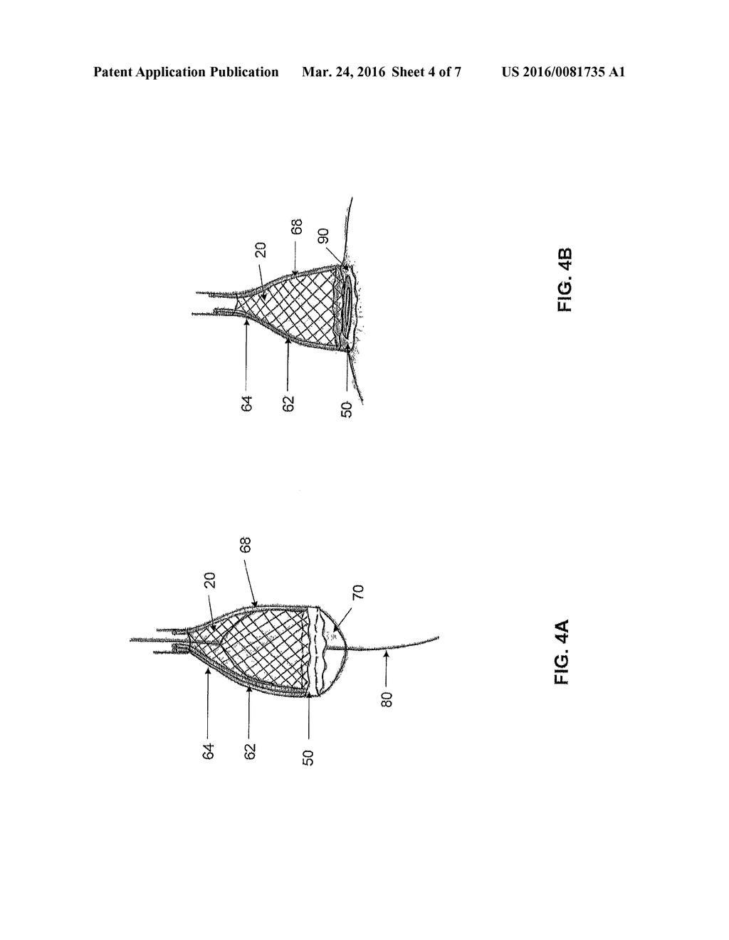 SYSTEMS AND METHODS FOR CRYOABLATION OF A TISSUE - diagram, schematic, and image 05