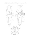 METHOD FOR PLACING IMPLANT USING ROBOTIC SYSTEM diagram and image