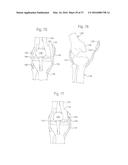 METHOD FOR PLACING IMPLANT USING ROBOTIC SYSTEM diagram and image