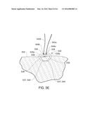 MEDICAL DEVICE, KIT AND METHOD FOR CONSTRICTING TISSUE OR A BODILY     ORIFICE, FOR EXAMPLE, A MITRAL VALVE diagram and image