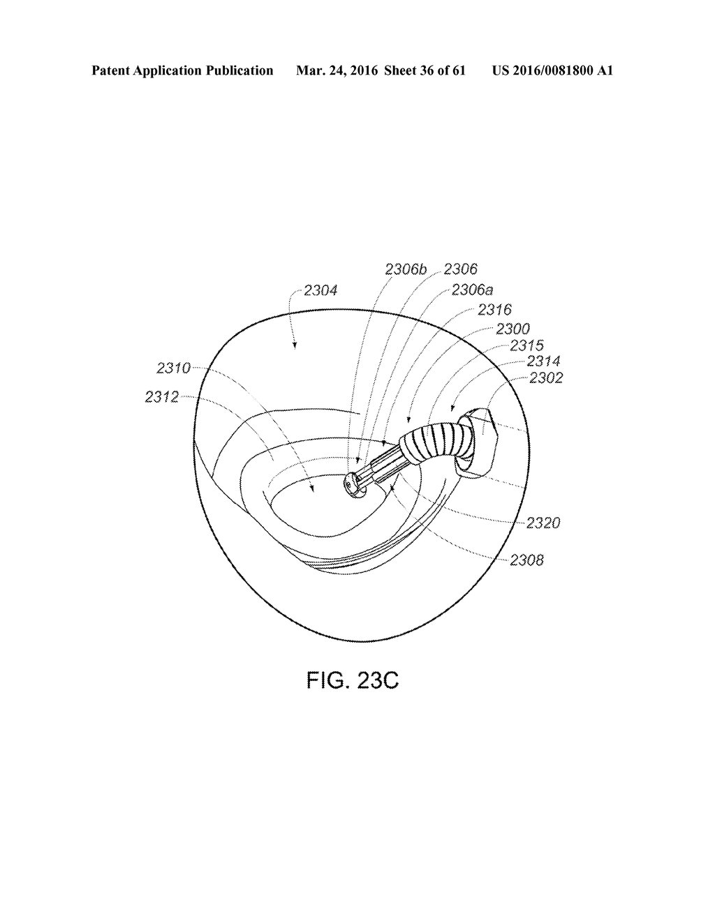 MEDICAL DEVICE, KIT AND METHOD FOR CONSTRICTING TISSUE OR A BODILY     ORIFICE, FOR EXAMPLE, A MITRAL VALVE - diagram, schematic, and image 37