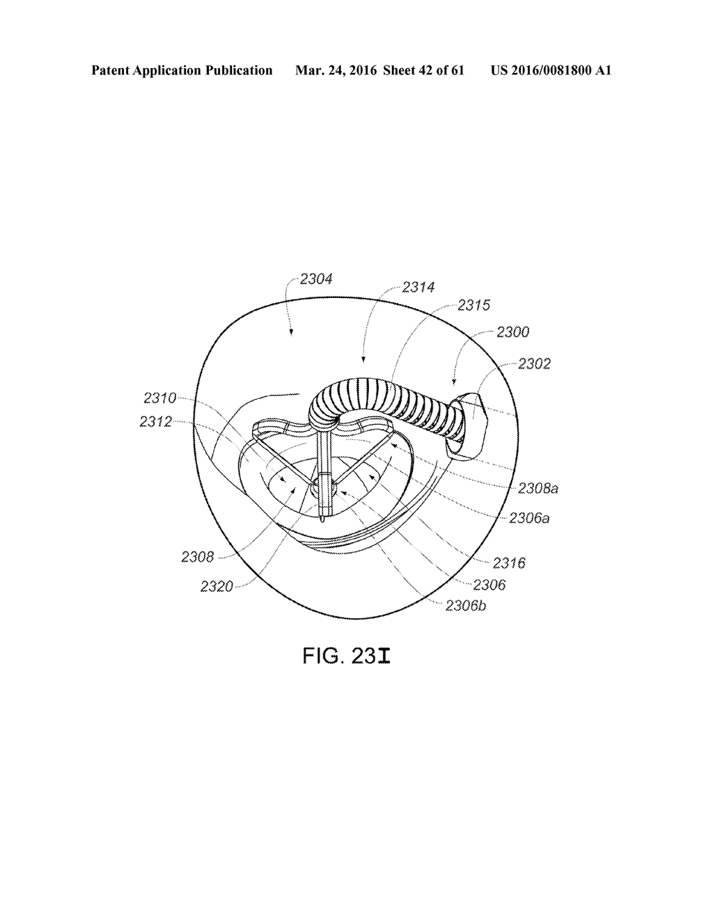 MEDICAL DEVICE, KIT AND METHOD FOR CONSTRICTING TISSUE OR A BODILY     ORIFICE, FOR EXAMPLE, A MITRAL VALVE - diagram, schematic, and image 43