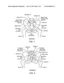 IMPLANTS FOR BONE FIXATION OR FUSION diagram and image