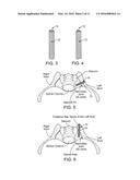 IMPLANTS FOR BONE FIXATION OR FUSION diagram and image