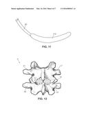 INTERVERTEBRAL SPINAL IMPLANT AND METHOD diagram and image
