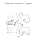 INTERVERTEBRAL DISC PROSTHESIS AND METHOD diagram and image