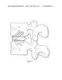 INTERVERTEBRAL DISC PROSTHESIS AND METHOD diagram and image