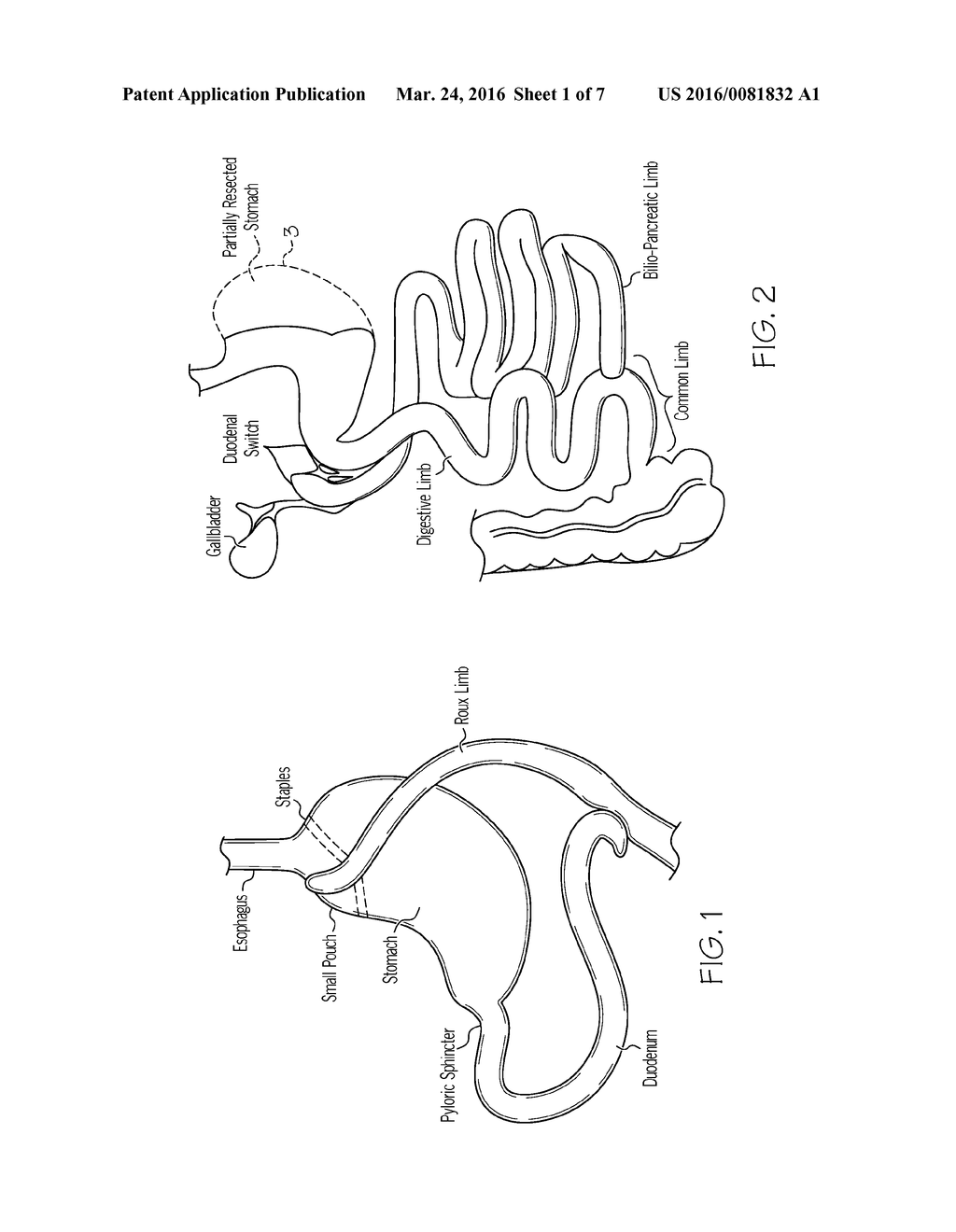 METHODS ALLOWING PYLORIC SPHINCTER TO NORMALLY FUNCTION FOR BARIATRIC     STENTS - diagram, schematic, and image 02