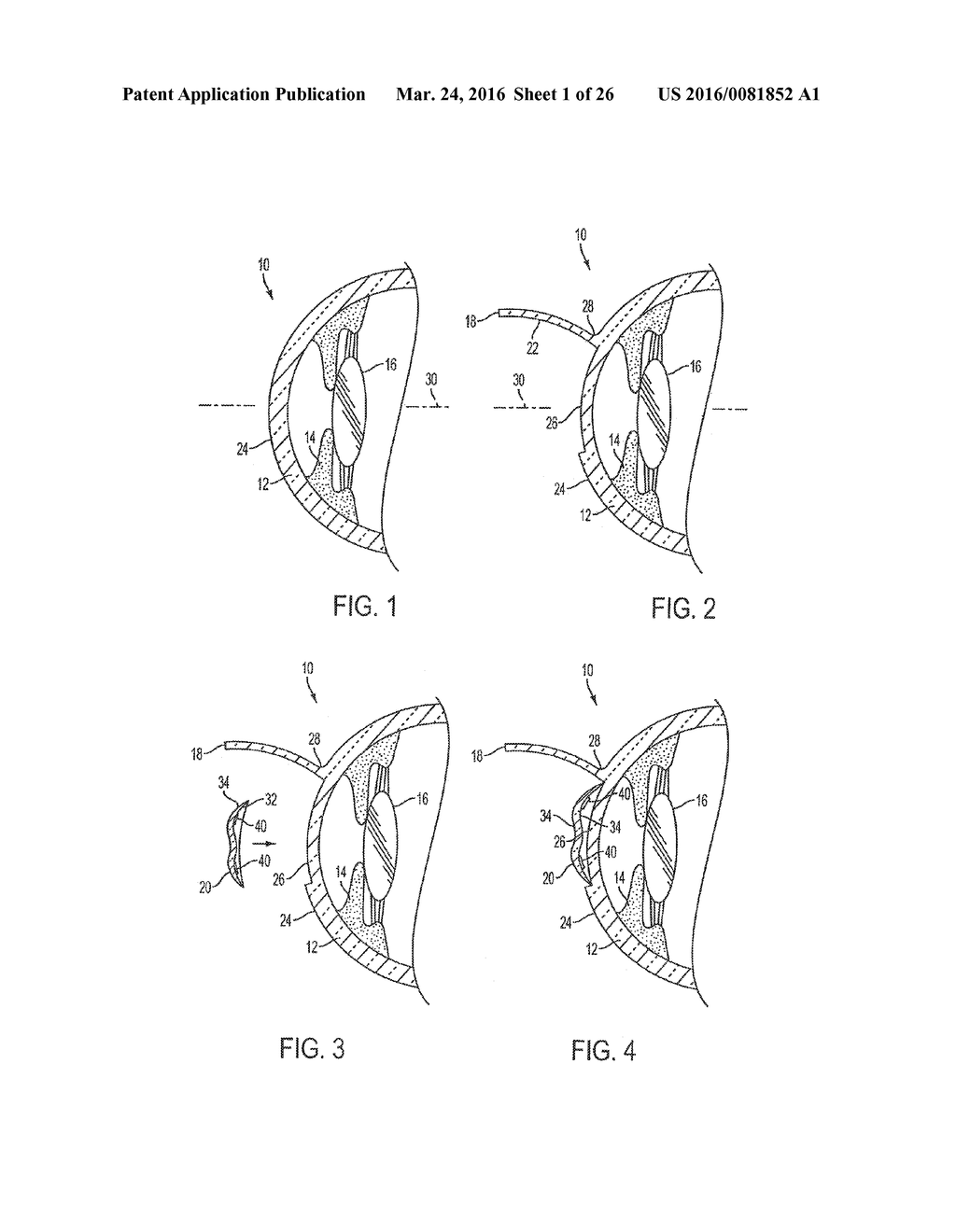 METHOD OF ALTERING THE REFRACTIVE PROPERTIES OF AN EYE - diagram, schematic, and image 02