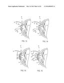 METHOD OF ALTERING THE REFRACTIVE PROPERTIES OF AN EYE diagram and image