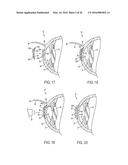 METHOD OF ALTERING THE REFRACTIVE PROPERTIES OF AN EYE diagram and image