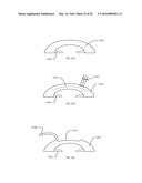 METHOD OF ALTERING THE REFRACTIVE PROPERTIES OF AN EYE diagram and image