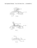 METHOD OF ALTERING THE REFRACTIVE PROPERTIES OF AN EYE diagram and image