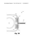 THIN PROFILE COCHLEAR IMPLANTS diagram and image