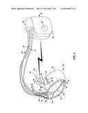 MEDICAL DEVICE FIXATION ATTACHMENT MECHANISM diagram and image