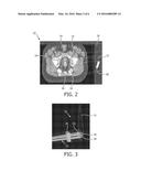 NEW TISSUE COMPENSATOR THICKNESS VISUALIZATION AND MODIFICATION TOOL FOR     USE IN RADIATION TREATMENT PLANNING diagram and image