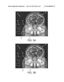 NEW TISSUE COMPENSATOR THICKNESS VISUALIZATION AND MODIFICATION TOOL FOR     USE IN RADIATION TREATMENT PLANNING diagram and image