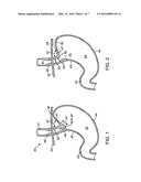 APPARATUS AND METHOD FOR MANIPULATING STOMACH TISSUE AND TREATING     GASTROESOPHAGEAL REFLUX DISEASE diagram and image