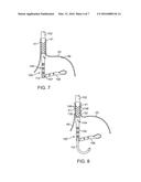 APPARATUS AND METHOD FOR MANIPULATING STOMACH TISSUE AND TREATING     GASTROESOPHAGEAL REFLUX DISEASE diagram and image