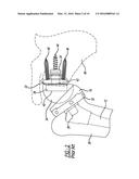 Adjustable Glenoid Pin Insertion Guide diagram and image