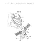 SURGICAL STABILIZER AND CLOSURE SYSTEM diagram and image