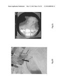 Orthopedic Implant Kit diagram and image