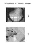 Orthopedic Implant Kit diagram and image