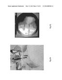 Orthopedic Implant Kit diagram and image