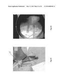 Orthopedic Implant Kit diagram and image