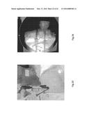 Orthopedic Implant Kit diagram and image