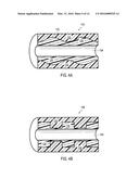 URETERAL STENTS WITH WAVEFORM INTERLAYERS AND INTERSTITCHING diagram and image