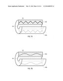 URETERAL STENTS WITH WAVEFORM INTERLAYERS AND INTERSTITCHING diagram and image