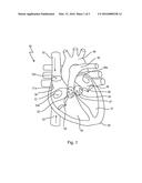 IMPLANTABLE DEVICE FOR TREATING MITRAL VALVE REGURGITATION diagram and image