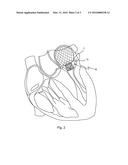 IMPLANTABLE DEVICE FOR TREATING MITRAL VALVE REGURGITATION diagram and image