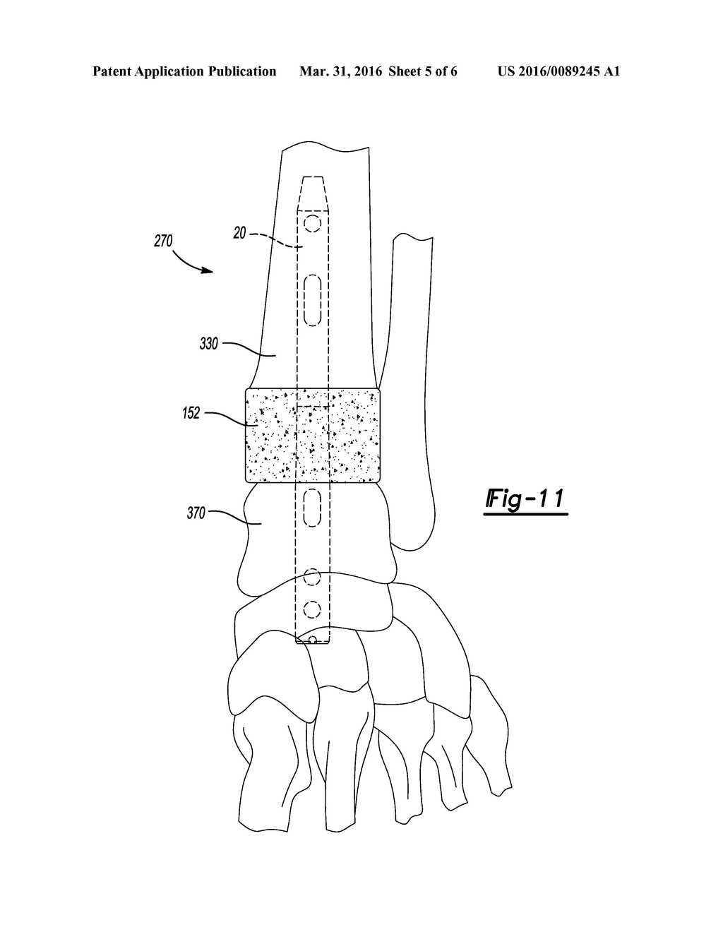 IMPLANTS FOR FIXATION OF THE DISTAL TIBIA - diagram, schematic, and image 06