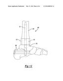 IMPLANTS FOR FIXATION OF THE DISTAL TIBIA diagram and image