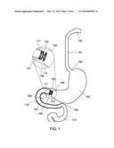 DELIVERY DEVICES AND METHODS FOR GASTROINTESTINAL IMPLANTS diagram and image