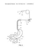 DELIVERY DEVICES AND METHODS FOR GASTROINTESTINAL IMPLANTS diagram and image