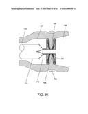 DELIVERY DEVICES AND METHODS FOR GASTROINTESTINAL IMPLANTS diagram and image