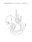 INTESTINAL SLEEVE diagram and image