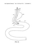 INTESTINAL SLEEVE diagram and image