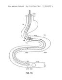 INTESTINAL SLEEVE diagram and image