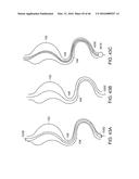 INTESTINAL SLEEVE diagram and image