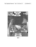 Device for Cancellation of Large Magnetic Susceptibility Artifacts in     Magnetic Resonance Imaging of Patients with Pacemakers and Implantable     Cardiac Defibrillators diagram and image