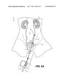 ATTACHMENT DEVICE FOR A URETEROSCOPE diagram and image