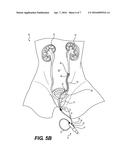 ATTACHMENT DEVICE FOR A URETEROSCOPE diagram and image