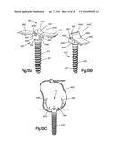 SPINAL STABILIZING AND GUIDING FIXATION SYSTEM diagram and image