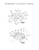 SPINAL STABILIZING AND GUIDING FIXATION SYSTEM diagram and image