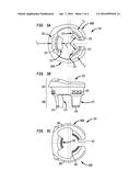 PERIPROSTHETIC EXTENSION PLATE diagram and image