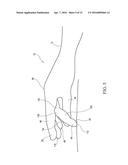 SURGICAL GLOVE SYSTEMS AND METHOD OF USING THE SAME diagram and image